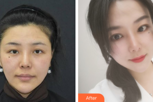 肇庆市皮肤病医院医疗美容科谭以和整形价格表附激光祛斑案例展示