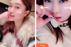肇庆市皮肤病医院医疗美容科罗中权整形价格表附果酸焕肤案例展示