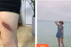 东莞市人民医院医学美容科廖旭锋整形价格表附疤痕增生案例展示