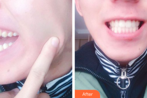 东莞知美整形医院谢荣寿整形价格表附牙齿隐形矫正案例展示