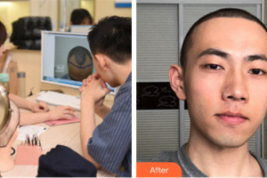 东莞美立方美容医院徐霞整形价格表附种植发际线案例展示