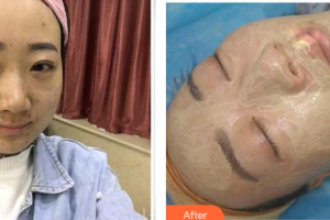 东莞百佳玛丽亚妇产医院赵杨整形价格表附微针案例展示