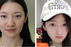 东莞韩美整形医院金贤珠整形价格表附激光祛斑案例展示