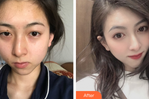 东莞缔美整形美容医院黄维林整形价格表附热玛吉案例展示