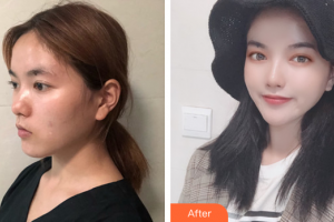 东莞缔美整形美容医院马可·斯塔比整形价格表附埋线提升提升案例展示