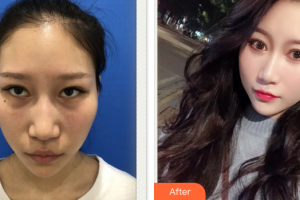 东莞瑞芙臣医疗美容门诊部王贵贤整形价格表附激光去眼袋案例展示