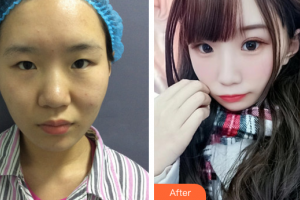 东莞非凡美容医院颜江整形价格表附眼部综合案例展示