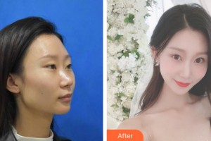 河南省人民医院整形美容中心李昊整形价格表附鼻部手术案例展示