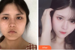 河南省整形美容研究中心李媛整形价格表附皮肤美容案例展示