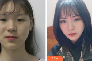 河南大学第一附属医院医疗美容科马杰整形价格表附双眼皮手术案例展示