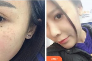 广东药科大学附属第一医院医疗美容科单孔荣整形价格表附激光祛斑案例展示