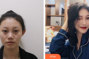 海南美咖医疗美容门诊部胡章超整形价格表附隆鼻手术案例展示