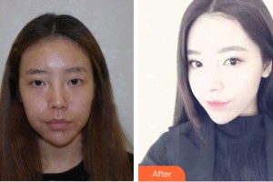 海南伊佳医疗美容医院闫运涛整形价格表附隆鼻手术案例展示