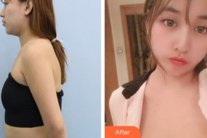 海南瑞韩医学美容医院杨永成整形价格表附自体脂肪隆胸案例展示