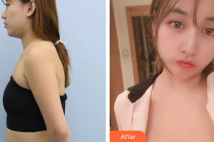 海南韩美医学美容医院梁如光整形价格表附自体脂肪丰胸案例展示