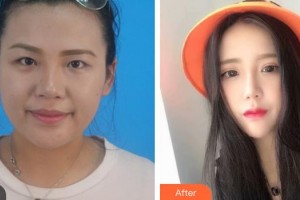 昆明医科大学第二附属医院整形外科王继华整形价格表附切开双眼皮案例展示