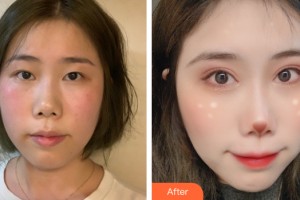 南宁熠美医疗美容诊所徐赞正整形价格表附双眼皮手术案例展示