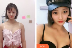 南宁华美整形美容医院布莱恩.肯尼博士整形价格表附自体脂肪丰胸案例展示