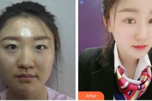 昆明普瑞眼科医院袁援生整形价格表附定点双眼皮案例展示