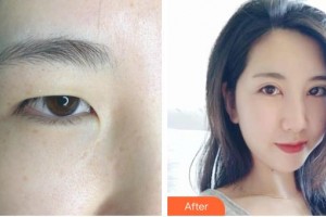 昆明普瑞眼科医院钱婷整形价格表附眼部综合案例展示