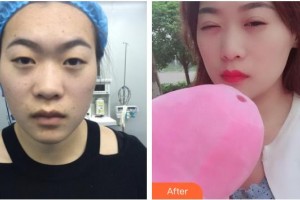 昆明普瑞眼科医院何守科整形价格表附定点双眼皮案例展示