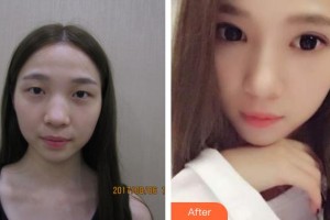 昆明普瑞眼科医院叶计芬整形价格表附切开双眼皮案例展示