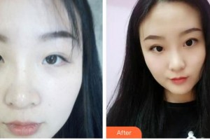 玉溪爱尔眼科医院刘莎利整形价格表附眼部综合案例展示