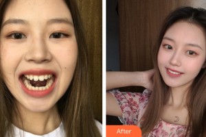 武汉唯韩医疗美容门诊部金永勋整形价格表附牙齿矫正案例展示