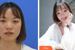 河北现代女子医院整形美容中心翟奈颖整形价格表附定点双眼皮案例展示