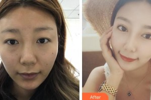 河北现代女子医院整形美容中心赵国辉整形价格表附切开双眼皮案例展示