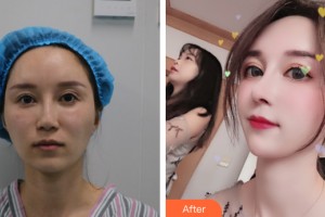 武汉艺星医疗美容医院岳金堂整形价格表附鼻部手术案例展示