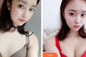 唐山美泉医疗美容诊所王景锋整形价格表附自体脂肪隆胸案例展示