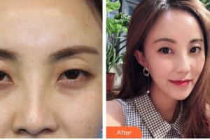 唐山冀东眼科医院李春江整形价格表附眼部综合案例展示