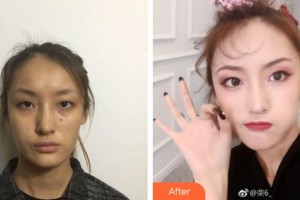 唐山星光医疗美容门诊部白玲整形价格表附去痘印痘坑案例展示