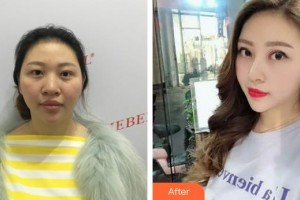 邢台美加美医疗美容诊所韩伟强整形价格表附激光美肤激光案例展示