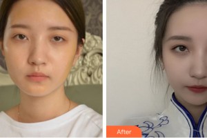 中山爱思特美容医院　陈子瑾整形价格表附自体脂肪填充案例展示