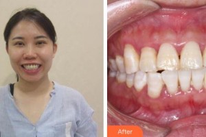 保定东阳口腔医院赵星整形价格表附牙齿隐形矫正案例展示