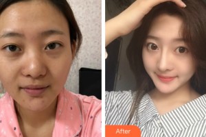 哈尔滨禾力康医疗美容医院赵金阳整形价格表附隆鼻手术案例展示