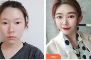 沧州华美医疗美容医院张超院长整形价格表附埋线双眼皮案例展示
