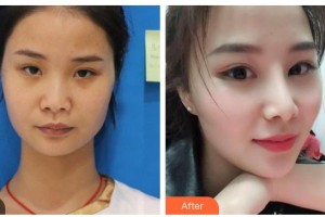 廊坊荣霞医疗美容诊所陈小迪整形价格表附鼻部综合案例展示