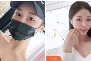 山西现代妇产医院整形美容中心赵建华整形价格表附去痘印痘坑案例展示