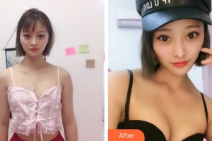 太原华美整形美容医院程晓林整形价格表附隆胸手术案例展示