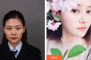 桂林创美医疗整形美容门诊部张克勤整形价格表附鼻部手术案例展示