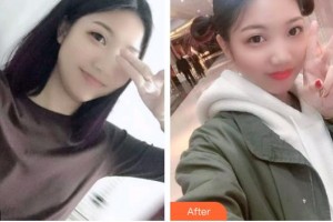 太原爱尔眼科医院刘爱平整形价格表附眼部综合案例展示