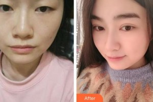 太原星范医疗美容门诊部兰秀琴整形价格表附眼部修复案例展示