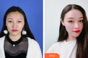 西宁夏都医疗美容医院李广智整形价格表附鼻部手术案例展示