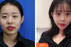 西宁韩亚医疗美容诊所韩玲整形价格表附眼部手术案例展示