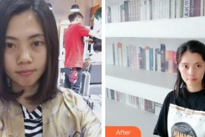 内蒙古佳丽医疗美容诊所张振林整形价格表附光子嫩肤案例展示