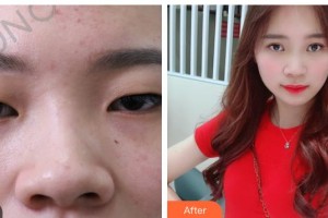 呼和浩特任荣大韩医疗美容诊所刘豪整形价格表附埋线双眼皮案例展示