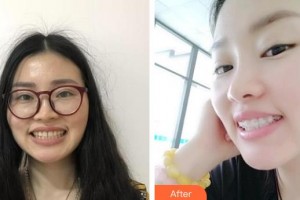 包头贝特瑞尔口腔门诊部冯露住院医师整形价格表附美白剂美白牙齿案例展示